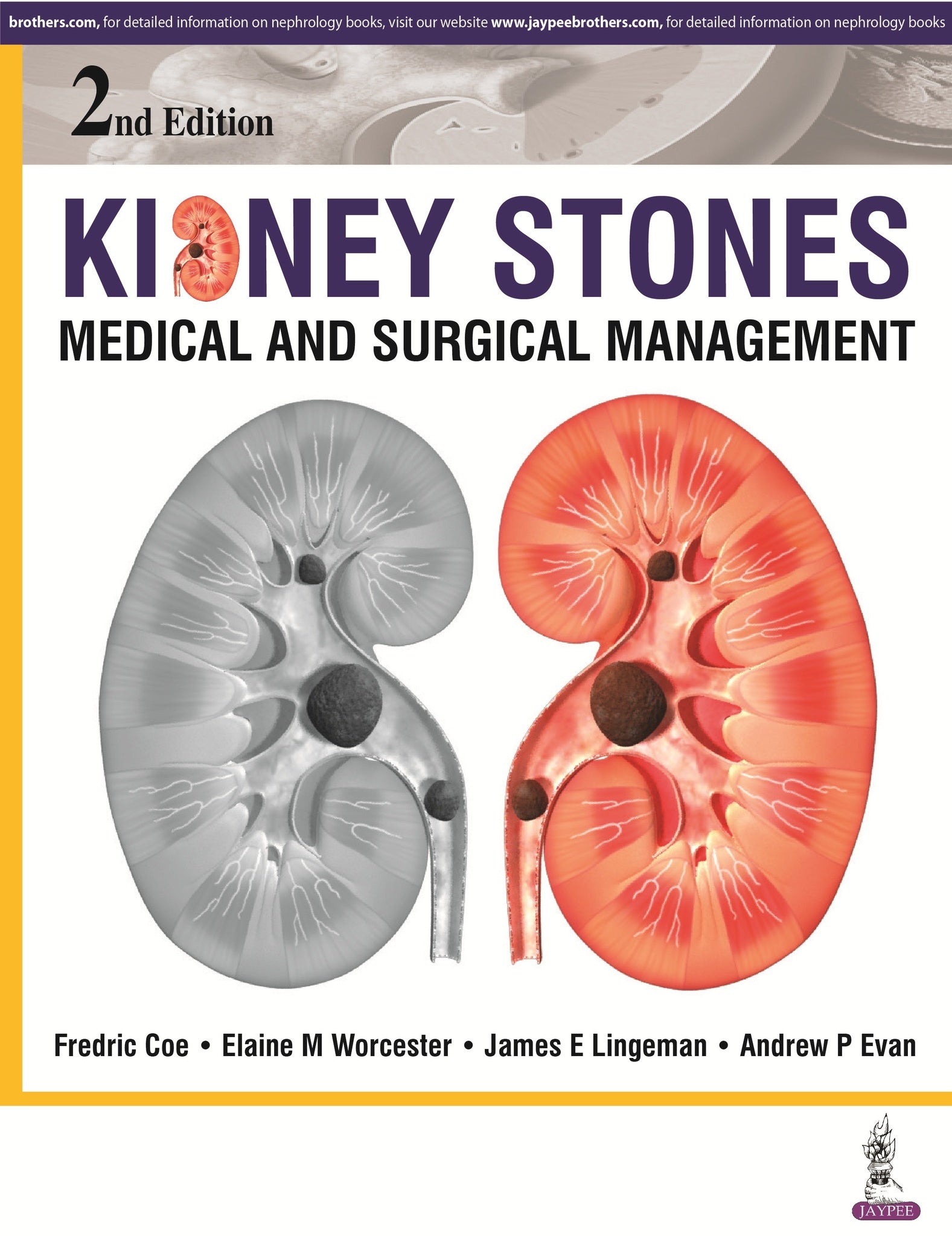 Kidney Stones